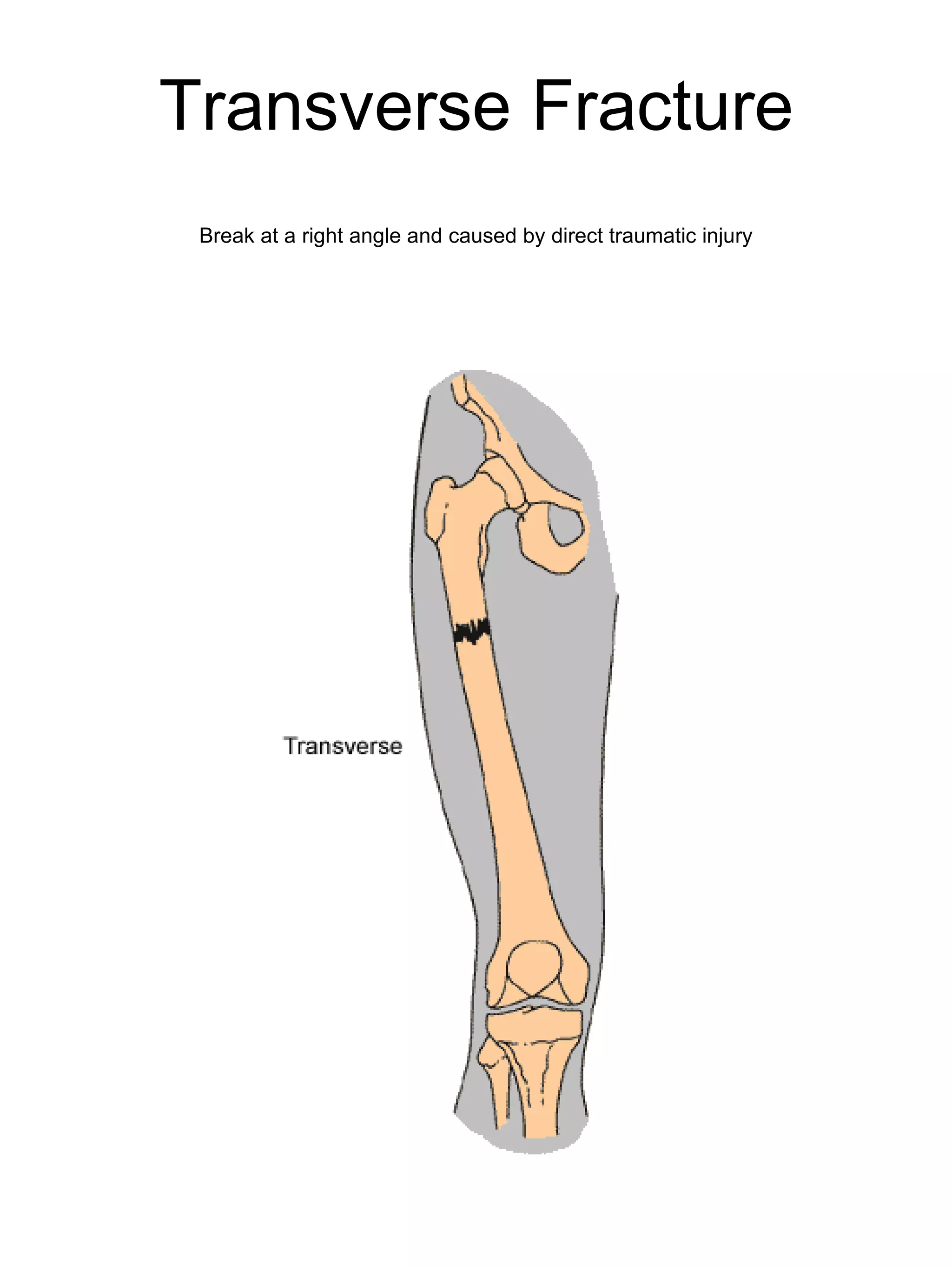 Transverse Fracture Break at a right angle and caused by direct traumatic injury 
