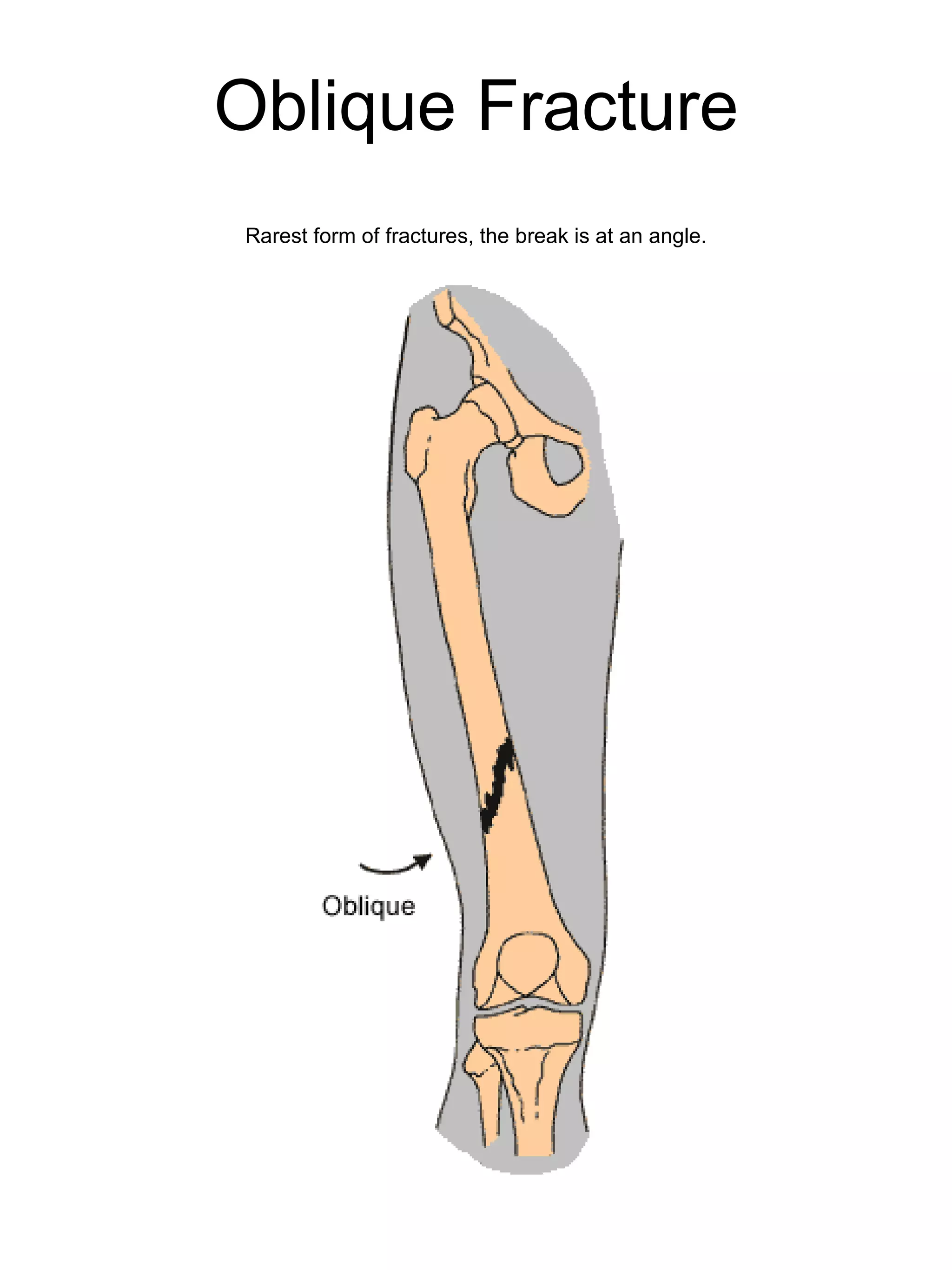 Oblique Fracture Rarest form of fractures, the break is at an angle. 