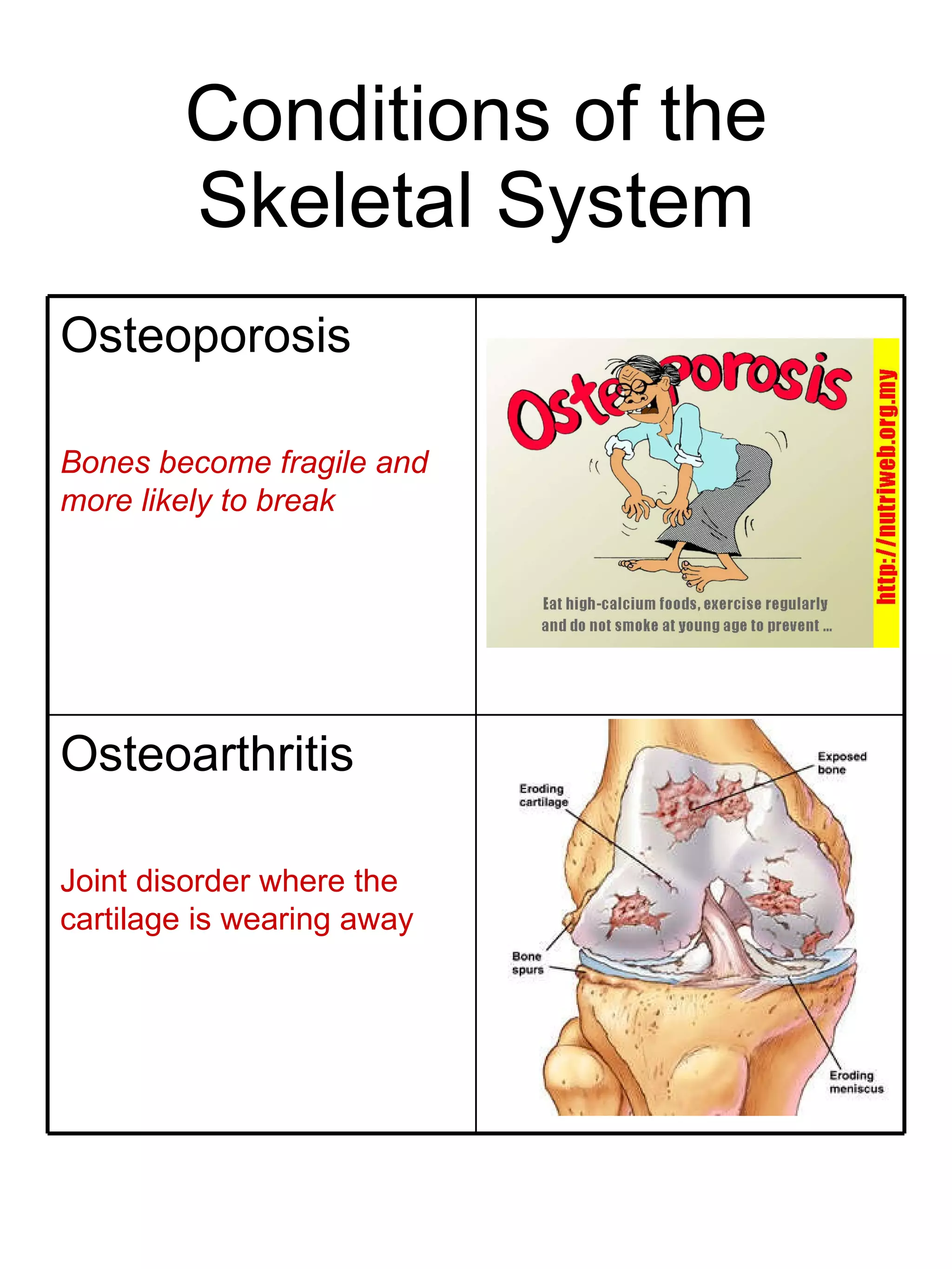Conditions of the Skeletal System Osteoarthritis Joint disorder where the cartilage is wearing away Osteoporosis Bones become fragile and more likely to break 