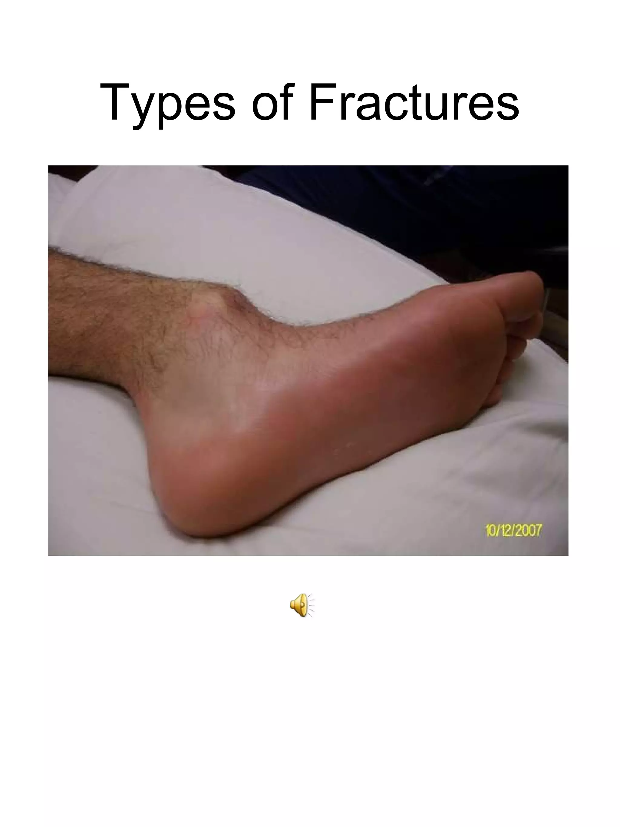 Types of Fractures 