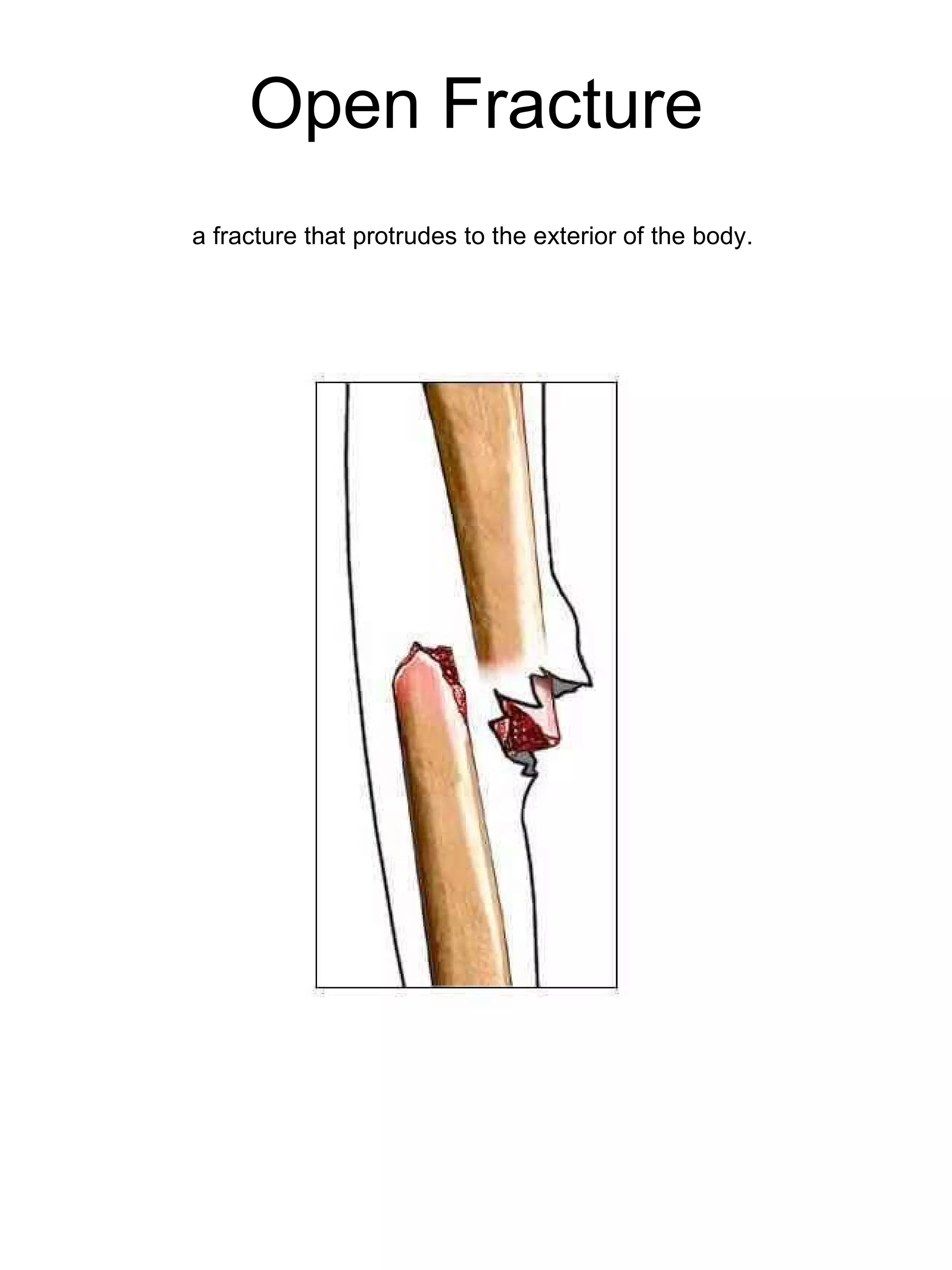 Open Fracture a fracture that protrudes to the exterior of the body.  