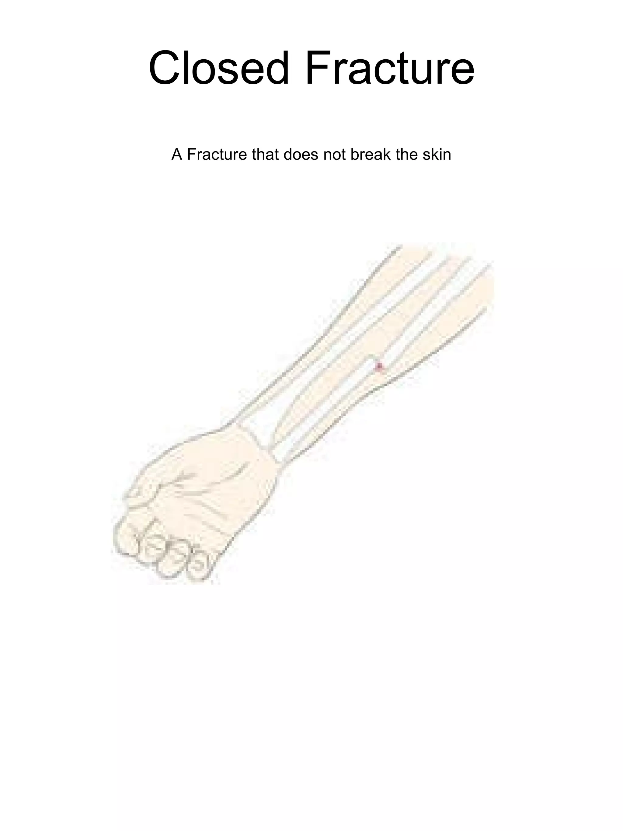 Closed Fracture A Fracture that does not break the skin 