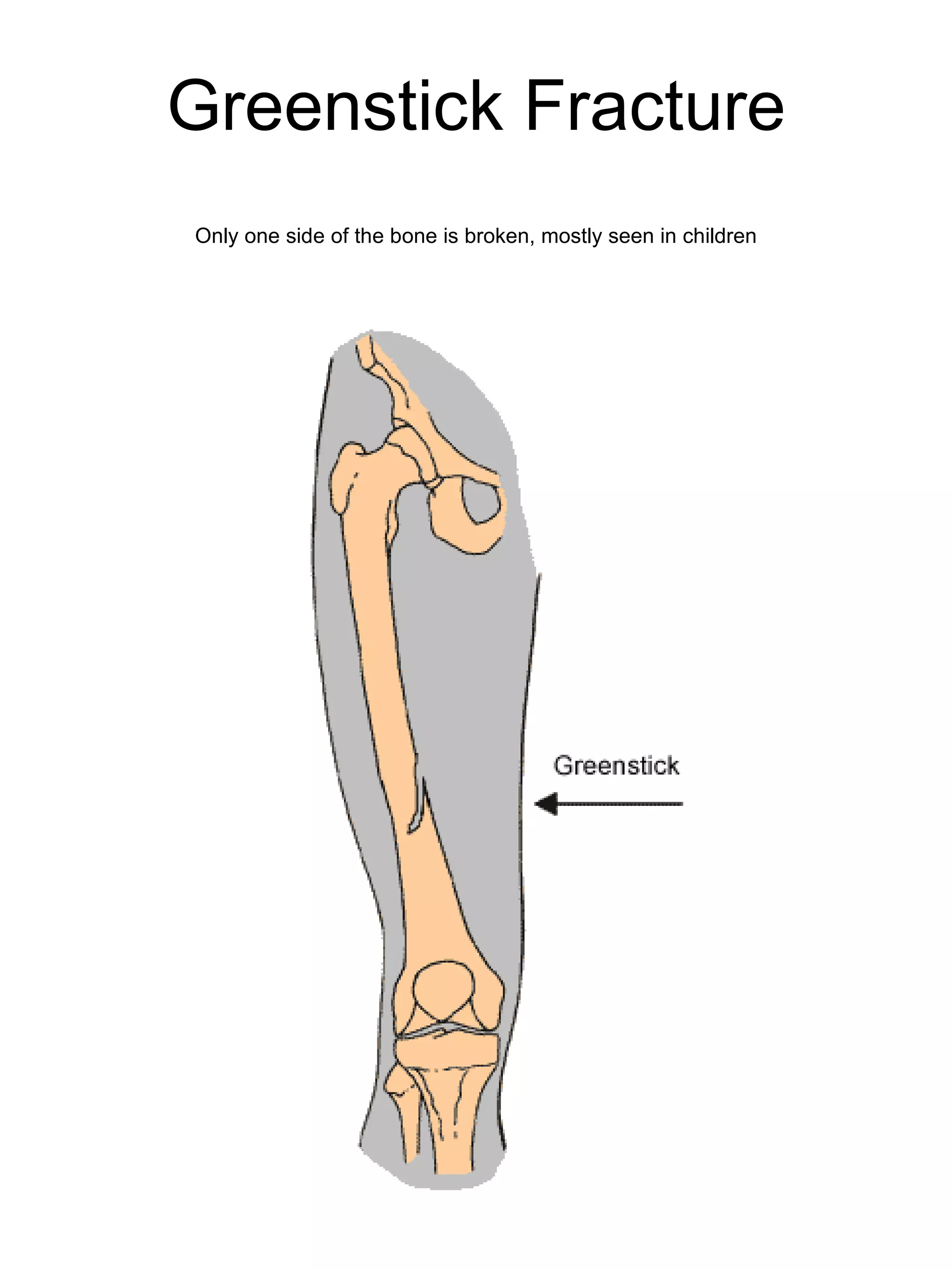 Greenstick Fracture Only one side of the bone is broken, mostly seen in children 