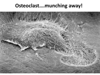 Osteoclast….munching away!
 