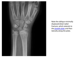 Note the oblique minimally
displaced distal radial
fracture, which extends to
the growth plate and then
laterally along the plate.
 
