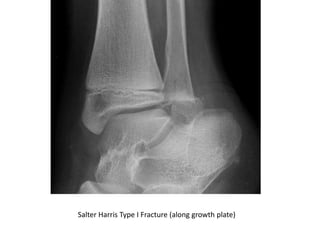 Salter Harris Type I Fracture (along growth plate)
 