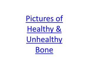 Pictures of
Healthy &
Unhealthy
   Bone
 