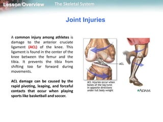 Lesson Overview             The Skeletal System


                                   Joint Injuries

  A common injury among athletes is
  damage to the anterior cruciate
  ligament (ACL) of the knee. This
  ligament is found in the center of the
  knee between the femur and the
  tibia. It prevents the tibia from
  shifting too far forward during
  movements.

  ACL damage can be caused by the
  rapid pivoting, leaping, and forceful
  contacts that occur when playing
  sports like basketball and soccer.
 