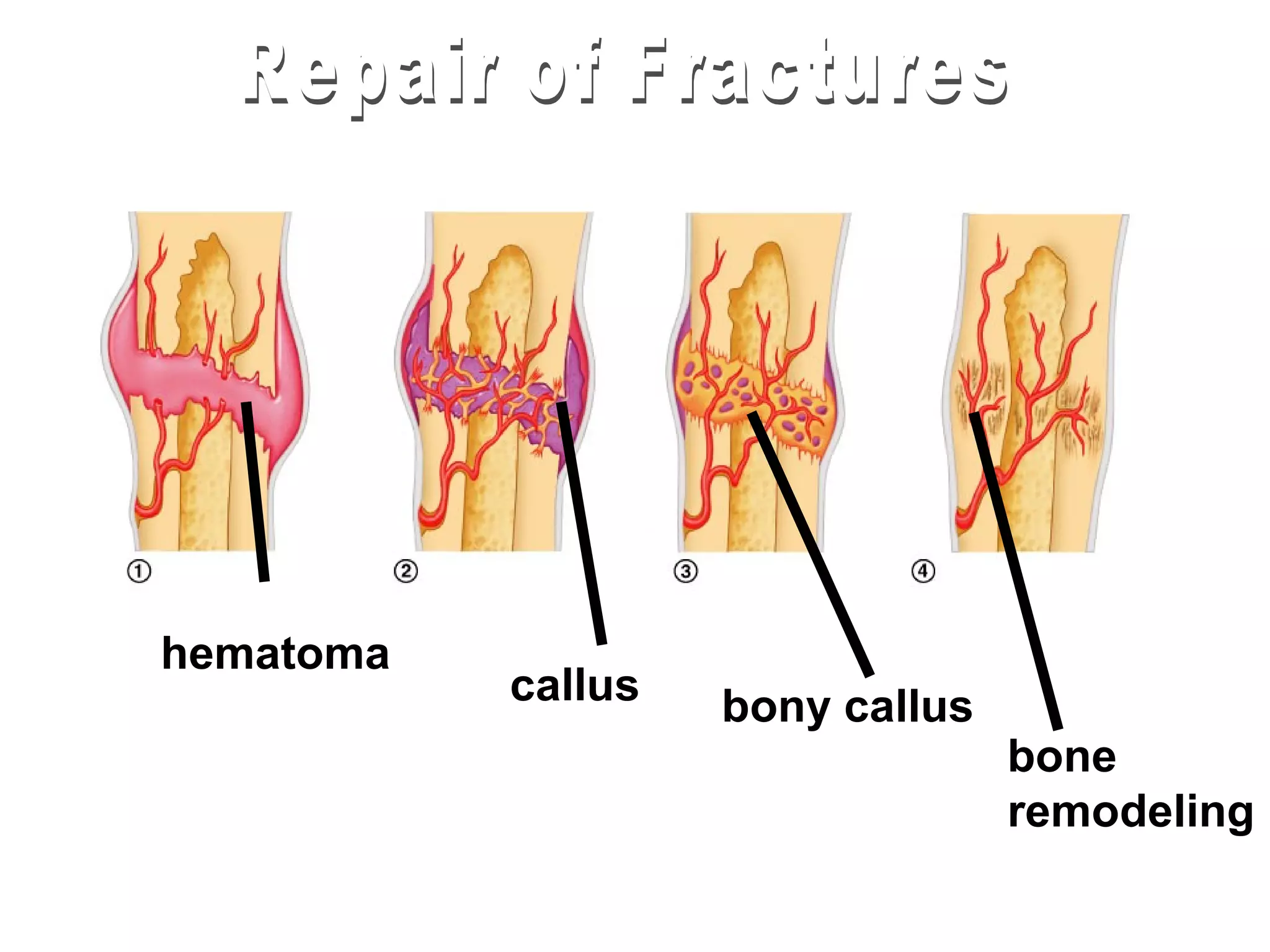 hematoma
           callus   bony callus
                                  bone
                                  remodeling
 