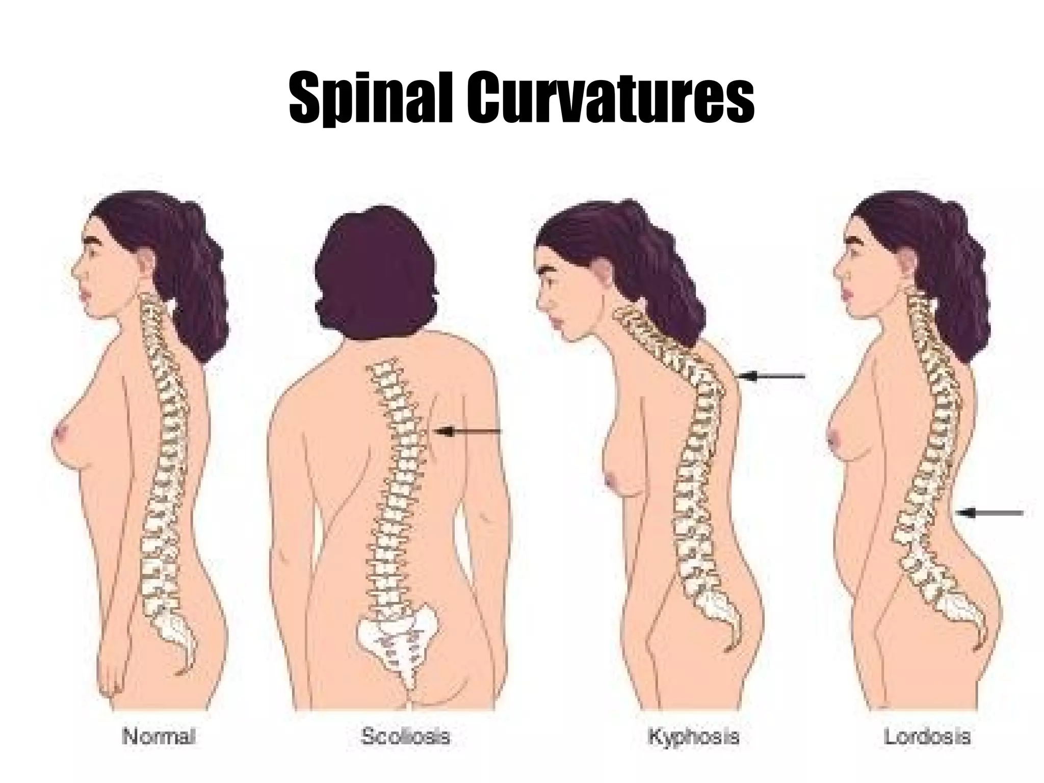 Spinal Curvatures
 