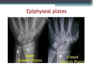 Epiphyseal plates
 