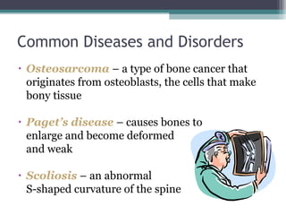 • Osteosarcoma – a type of bone cancer that
originates from osteoblasts, the cells that make
bony tissue
• Paget’s disease – causes bones to
enlarge and become deformed
and weak
• Scoliosis – an abnormal
S-shaped curvature of the spine
Common Diseases and Disorders
 