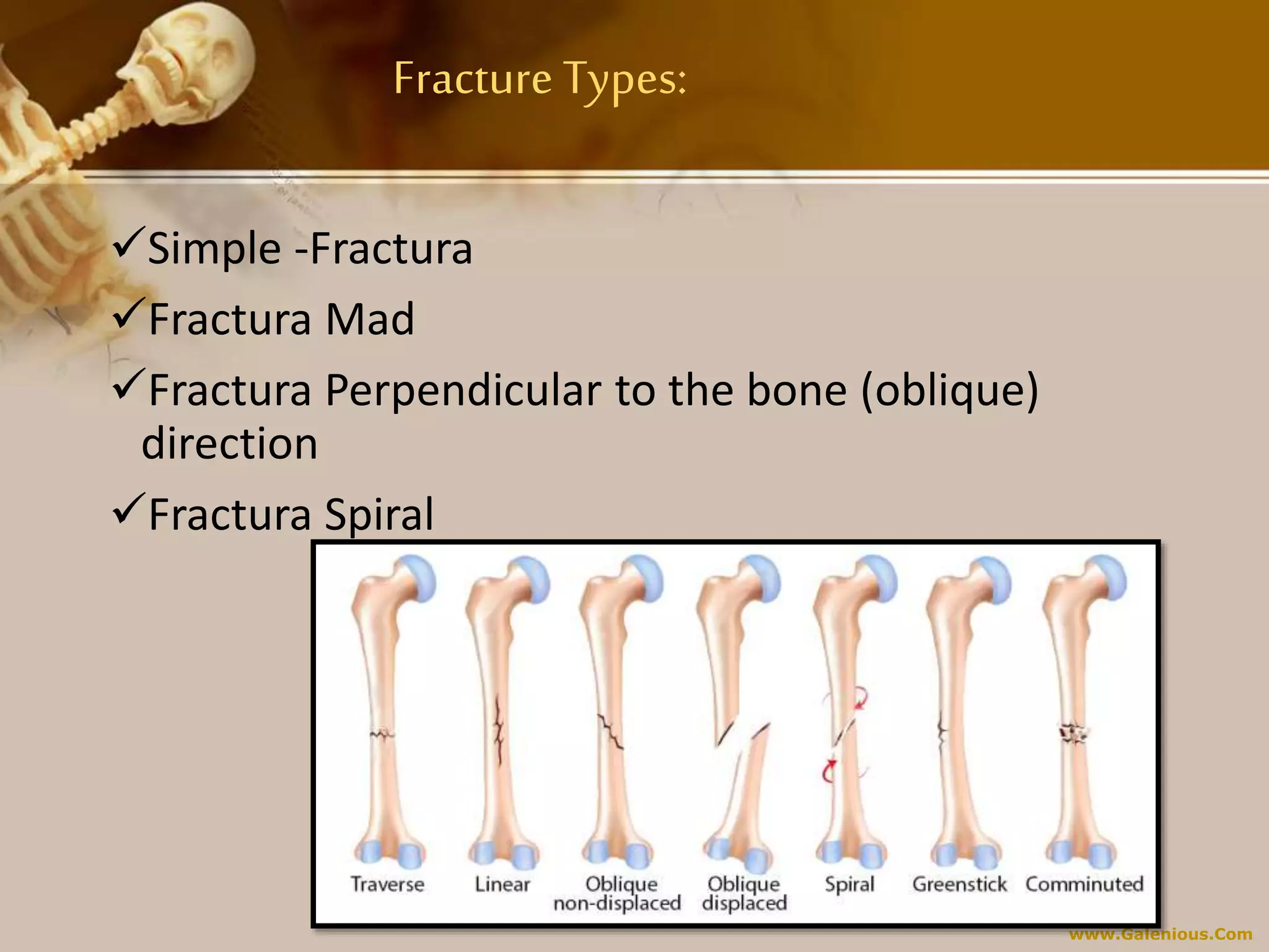www.Galenious.Com
Fracture Types:
Simple -Fractura
Fractura Mad
Fractura Perpendicular to the bone (oblique)
direction
Fractura Spiral
 