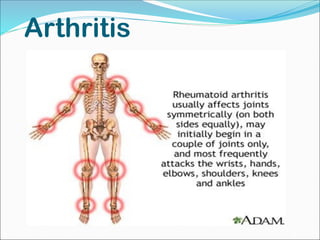 Arthritis
 