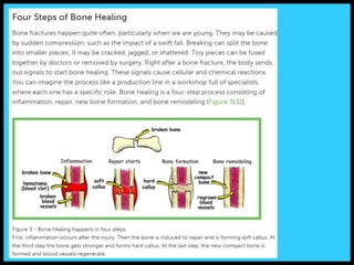 When a bone breaks…
 