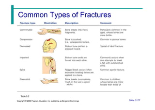 Common Types of Fractures
T
able 5.2
Slide 5.27
Copyright © 2003 Pearson Education, Inc. publishing as Benjamin Cummings
 