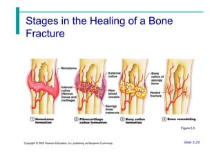 Stages in the Healing of a Bone
Fracture
Figure 5.5
Slide 5.29
Copyright © 2003 Pearson Education, Inc. publishing as Benjamin Cummings
 