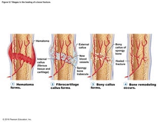 Initial Callus Formation SKELETAL SYSTEM PPT FOR THE BSN 1ST YEAR | PDF
