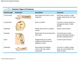 Fracture Types Table SKELETAL SYSTEM PPT FOR THE BSN 1ST YEAR | PDF