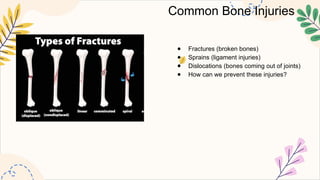 Common Bone Injuries
● Fractures (broken bones)
● Sprains (ligament injuries)
● Dislocations (bones coming out of joints)
● How can we prevent these injuries?
 