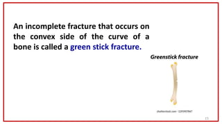 15
An incomplete fracture that occurs on
the convex side of the curve of a
bone is called a green stick fracture.
 