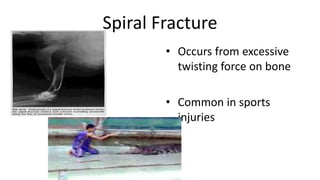 Spiral Fracture
• Occurs from excessive
twisting force on bone
• Common in sports
injuries
 