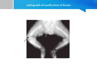 radiograph of ossification of bones
 