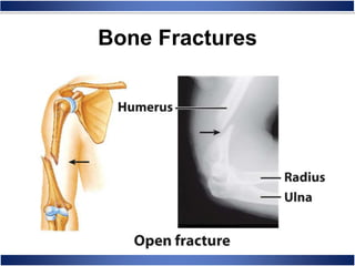 Bone Fractures
 