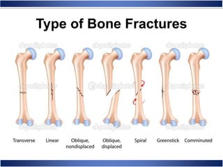 Type of Bone Fractures
 
