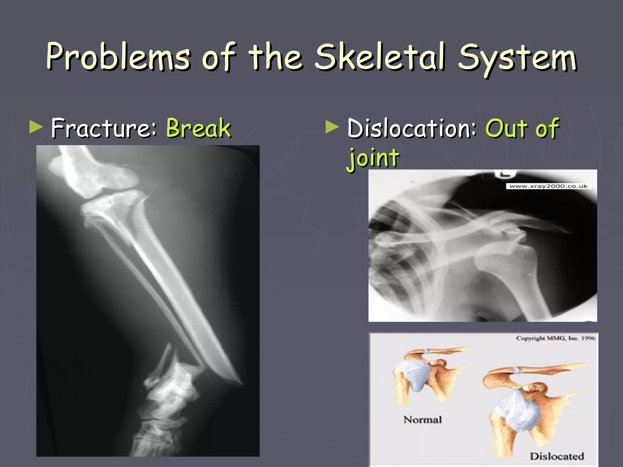 Problems of the Skeletal SystemProblems of the Skeletal System
► Fracture:Fracture: BreakBreak ► Dislocation:Dislocation: Out ofOut of
jointjoint
 