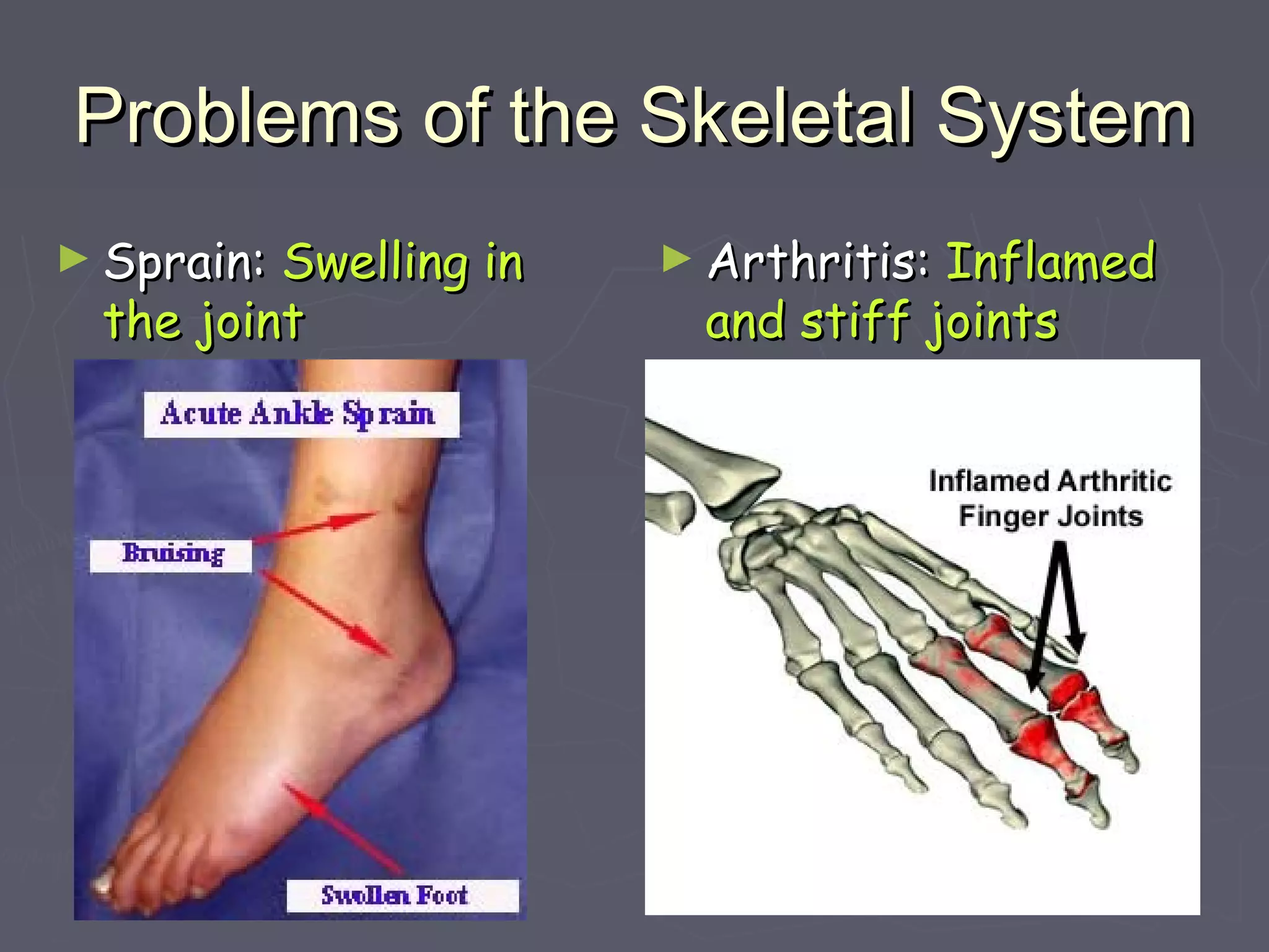 Problems of the Skeletal SystemProblems of the Skeletal System
► Sprain:Sprain: Swelling inSwelling in
the jointthe joint
► Arthritis:Arthritis: InflamedInflamed
and stiff jointsand stiff joints
 