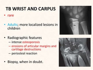 TB WRIST AND CARPUS
• rare
• Adults; more localized lesions in
children
• Radiographic features
– intense osteoporosis
– erosions of articular margins and
cartilage destructions
– periosteal reaction
• Biopsy, when in doubt.
 