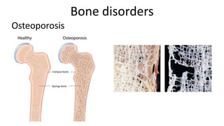 Bone disorders
Osteoporosis

 