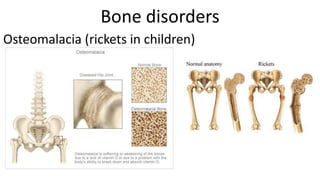 Bone disorders
Osteomalacia (rickets in children)

 