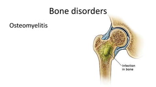 Bone disorders
Osteomyelitis

 