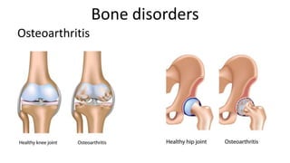 Bone disorders
Osteoarthritis

 