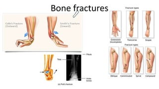 Bone fractures

 