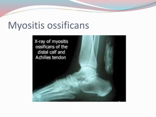 Myositis ossificans
 