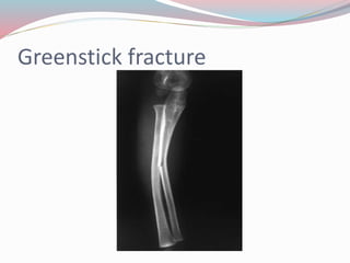 Greenstick fracture
 