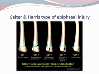 Salter & Harris type of epiphseal injury
 