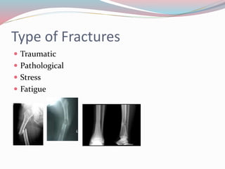Type of Fractures
 Traumatic
 Pathological
 Stress
 Fatigue
 