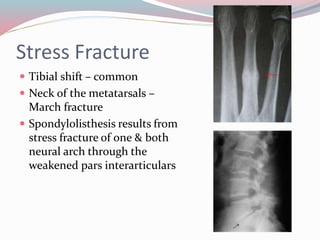 Stress Fracture
 Tibial shift – common
 Neck of the metatarsals –
March fracture
 Spondylolisthesis results from
stress fracture of one & both
neural arch through the
weakened pars interarticulars
 