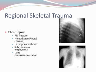 Regional Skeletal Trauma
 Chest injury
 Rib fracture
 Hemothorax(Pleural
effusion)
 Hemopneumothorax
 Subcutaneous
emphysema
 Lung
contusion/laceration
 