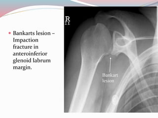  Bankarts lesion –
Impaction
fracture in
anteroinferior
glenoid labrum
margin.
 