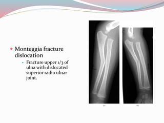  Monteggia fracture
dislocation
 Fracture upper 1/3 of
ulna with dislocated
superior radio ulnar
joint.
 