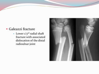  Galeazzi fracture
 Lower 1/3rd radial shaft
fracture with associated
dislocation of the distal
radioulnar joint
 