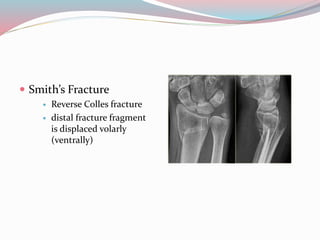  Smith’s Fracture
 Reverse Colles fracture
 distal fracture fragment
is displaced volarly
(ventrally)
 
