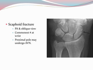  Scaphoid fracture
 PA & oblique view
 Commenest # at
wrist
 Proximal pole may
undergo AVN.
 