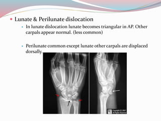  Lunate & Perilunate dislocation
 In lunate dislocation lunate becomes triangular in AP. Other
carpals appear normal. (less common)
 Perilunate common except lunate other carpals are displaced
dorsally.
 