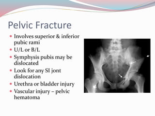 Pelvic Fracture
 Involves superior & inferior
pubic rami
 U/L or B/L
 Symphysis pubis may be
dislocated
 Look for any SI jont
dislocation
 Urethra or bladder injury
 Vascular injury – pelvic
hematoma
 